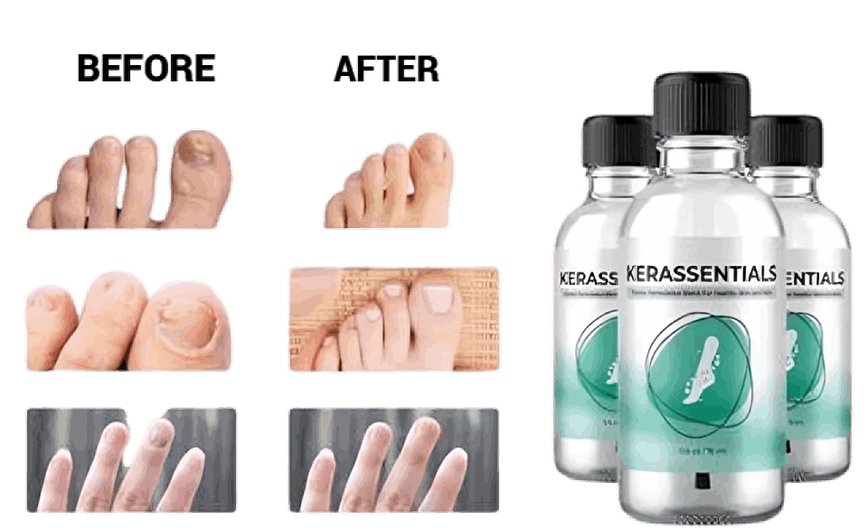 Kerassentials